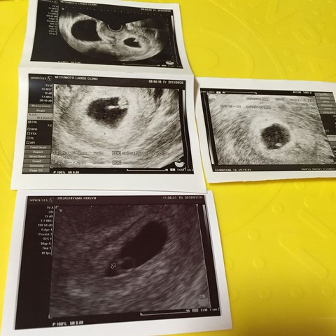 上面是大宝的早期圆形孕囊,女孩
