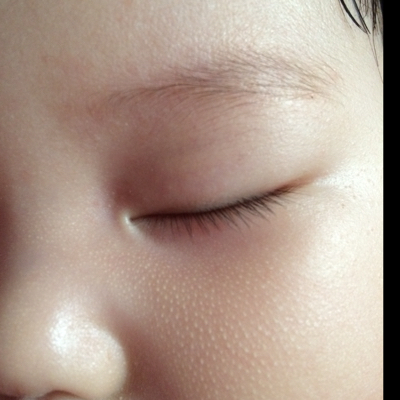 想知道宝宝鼻翼两侧两颊处的这些小白点点是什麼呀?好像从出生就有