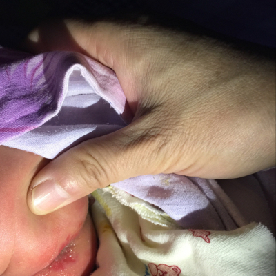 11个月宝宝长痔疮图片图片
