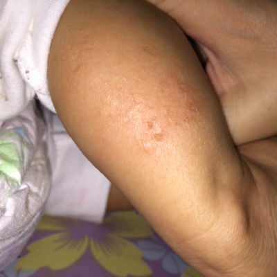 一个月婴儿湿疹图片图片