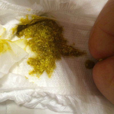 求助,宝宝这是怎麼了,拉屎怎麼会是这样阿!