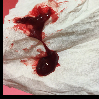 恶露没有排乾净,之前白色又变成淡粉,昨天流血,像月经,今天突然多了