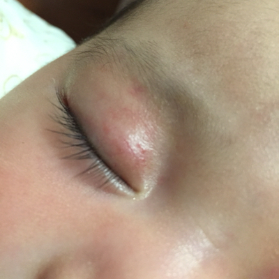 宝宝眼睛周围有小红点图片
