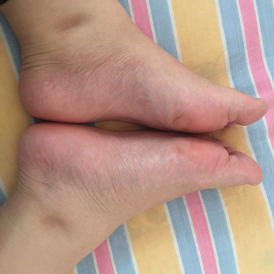 预产期到了还没生,脚踝这肿成这样有事没_宝宝树