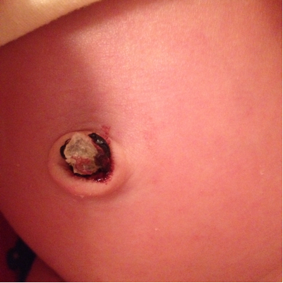 宝宝肚脐有个洞图图片