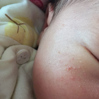 宝宝20天了,脸上出这种痘痘,好几天都下不去,怎麼办?
