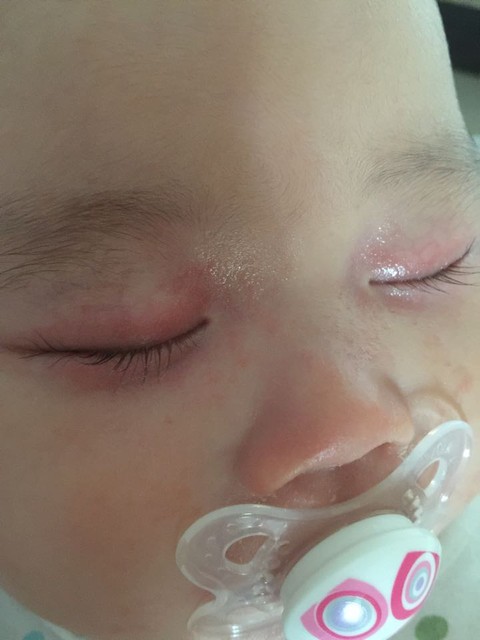 这个眼睛上的湿疹,能帮我问问怎么办,能擦什么药吗?