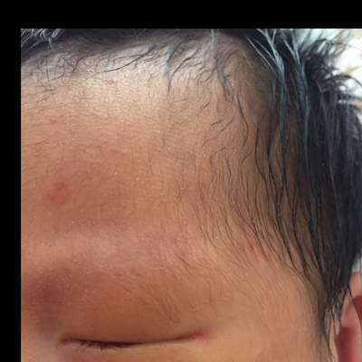 宝宝脸上长了湿疹,是头上的胎脂没有清理的原因吗?