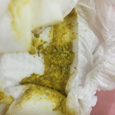 宝宝刚满月每天大便都是这样块的,怎麼回事啊!纯母乳餵养