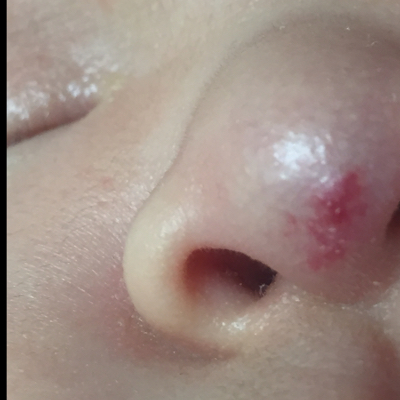 请问这是血管瘤吗?