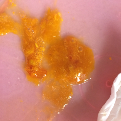 宝宝腹泻已经有半个月了 今天大便里有血丝. 怎麼办 是怎麼回事