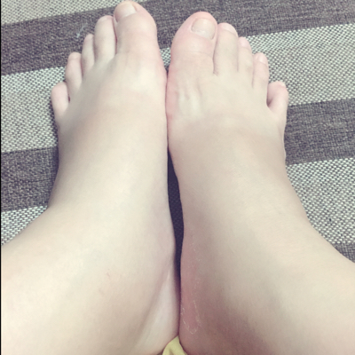 现在才孕19周,脚就出现水肿,是什麼原因呢?能否支招缓解,谢谢!