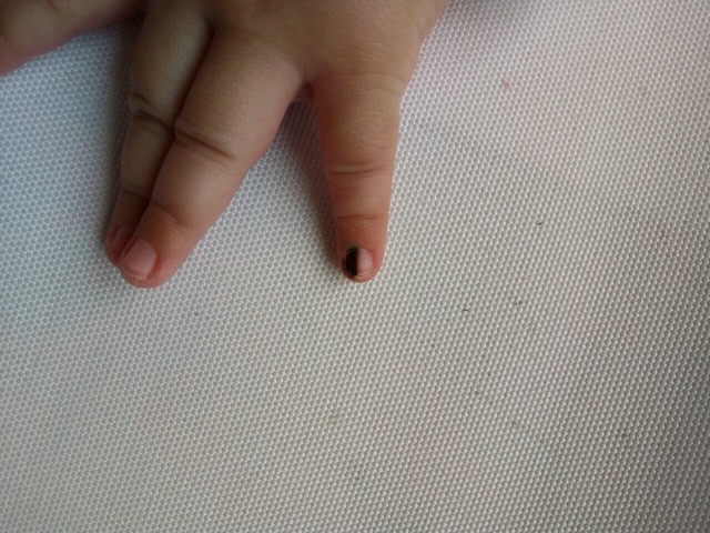 宝宝出生被怀疑黑色素瘤,跪求宝妈帮助