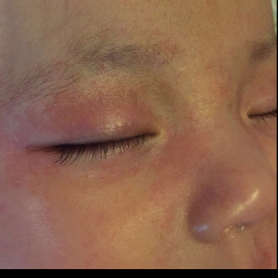 推荐回答                      一般是宝宝皮肤层比较薄,空气中杂质