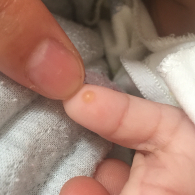 这种水泡,有宝妈知道吗?就大拇指内测一个,一天比一天大.