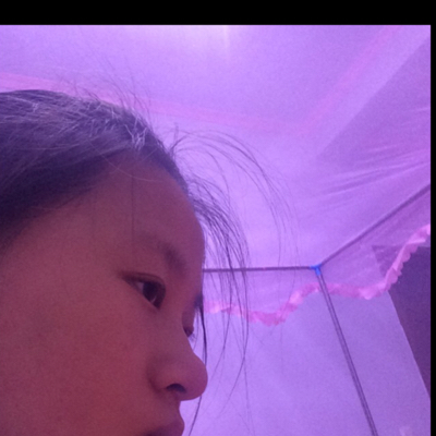 缩小鼻翼鼻头手术前后对比_缩小鼻翼鼻头手术能维持多久_鼻头鼻翼缩小