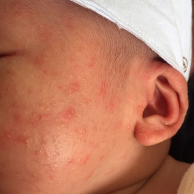 最近宝宝脸上和脑袋上长咯很多这样叻痘痘!