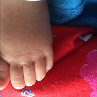 还出水,让儿科大夫看了说没事,但一星期了还没好,宝宝脚爱出汗,总潮