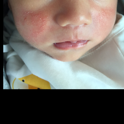 宝宝刚出生一个礼拜,脸上像是长了湿疹,红红的,怎麼办?