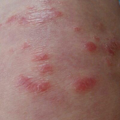 膝盖荨麻疹图片