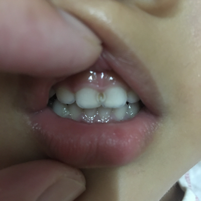 婴儿牙龈发黑未出牙图片
