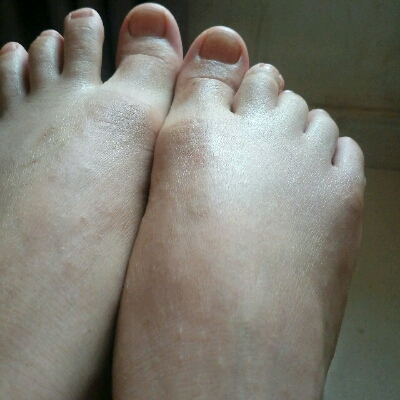 前几日发现脚长了一粒一粒的东东,拿手去扣,现在手上也长了.