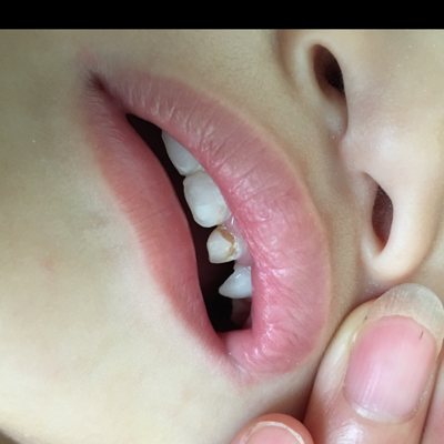 1岁宝宝上门牙龋齿图片