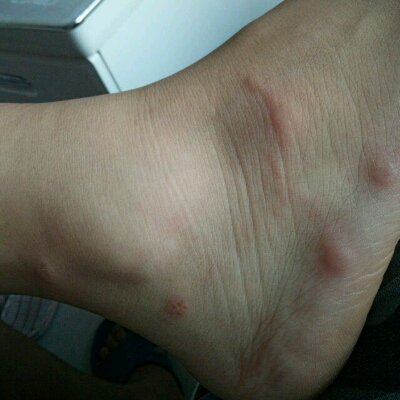 身上 脚上 腿上 都起了 刺挠死了 哪位宝妈知道这是什麼疙瘩 谁有高招