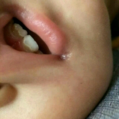 宝宝乳牙门牙腐蚀照片图片