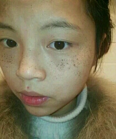 什么工纵耗啊,自从我怀孕后脸上的黑点点越来越多,身边朋友都说怀孕长