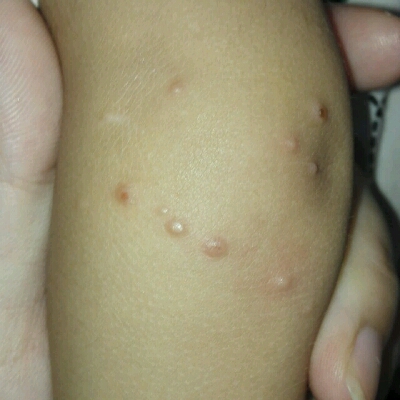 小孩手臂上长这个痘痘,能有什麼办法治愈?