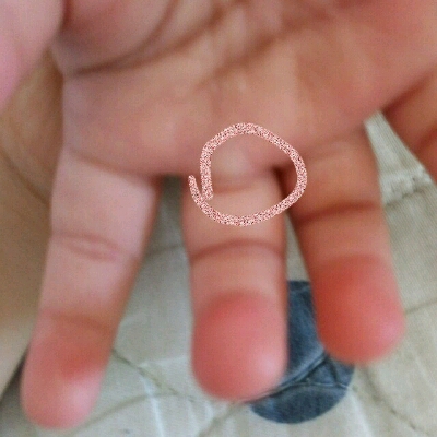 今天意外发现宝宝的手指关节处有一个豌豆大小的硬包,很像关节脱臼