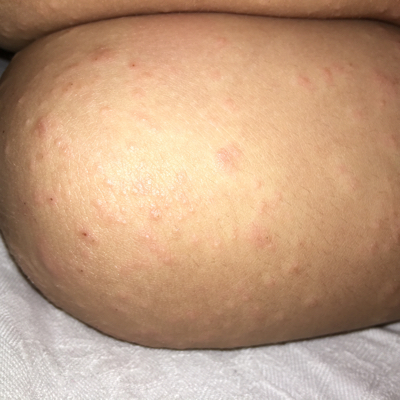 谁能告诉我这是沙土性皮炎吗?怎麼才能快好