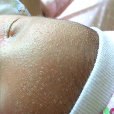 新生儿脸上透明水泡图图片