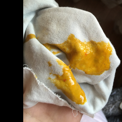 宝宝2个月零6天,屁股上长红色的小包包,但拉屎的时候稍微带了点血丝