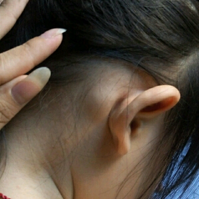 耳朵后面的淋巴结照片图片