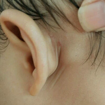 我家孩子从满月左耳朵后就有一个疙瘩,按着像是骨头似的,但是不是骨头