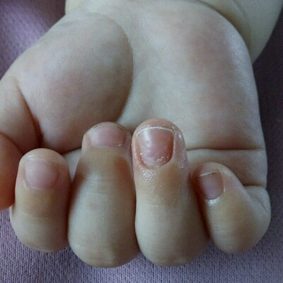 宝贝7个月,有一个手指的指甲和其他几个不同,摸着有凹凸感,巴巴赖赖不