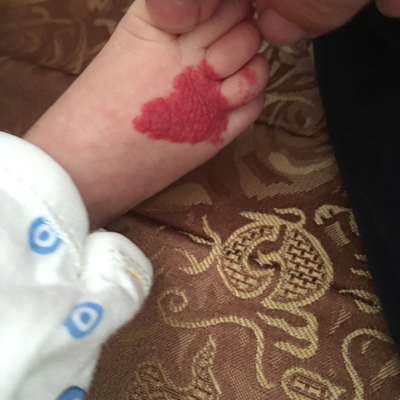 宝宝脚上有块红印 有人说是血管瘤 请问严重吗