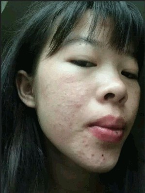 哎,我怀孕时一脸的黑.点,生过宝宝后又重了,都不知道怎么办了