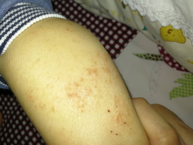 我家宝宝的小腿上有很多像湿疹样的症状,很痒,已经抓破了,请大家看看